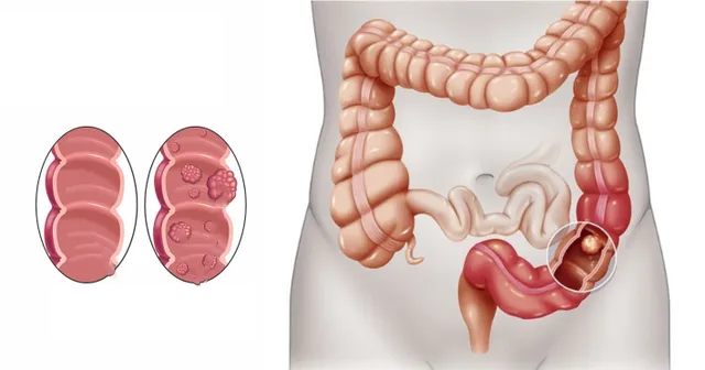 colon-cancer-ayurveda-treatment